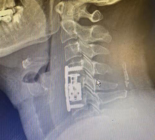 Hình ảnh vùng đốt sống cổ của người bệnh sau khi được thay đốt sống cổ nhân tạo