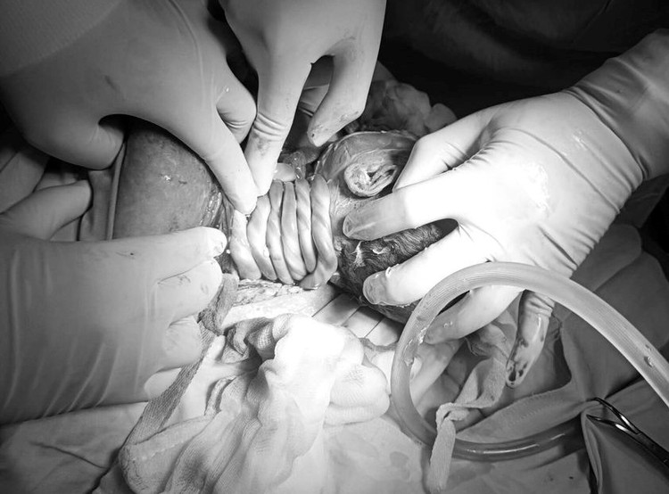 Cứu nguy thai nhi bị dây rốn quấn cổ 6 vòng ảnh 1