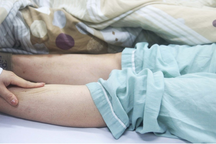 Biểu hiện của sốt xuất huyết ngoài da - Ảnh BVCC