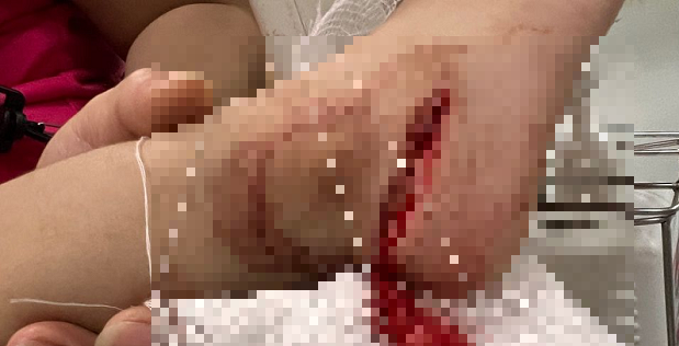 Trẻ 3 tuổi bị dao cứa đứt gân chân do người lớn bất cẩn ảnh 1