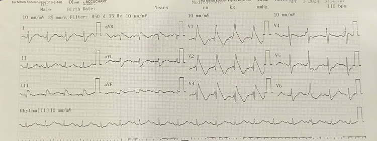 Điện tim người bệnh có hình ảnh Brugada typ 1