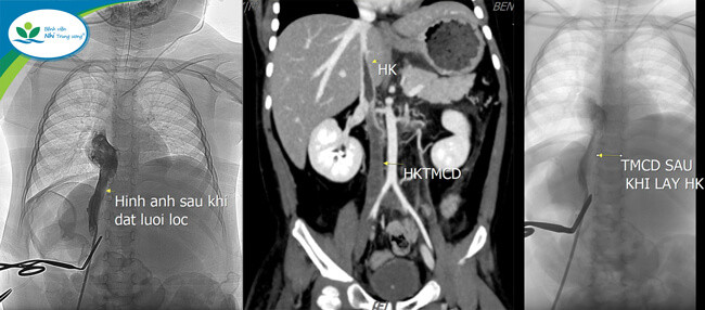 Hình ảnh huyết khối của trẻ trước và sau khi được phẫu thuật Hình ảnh huyết khối của trẻ trước và sau khi được phẫu thuật