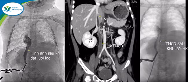 Hình ảnh huyết khối của trẻ trước và sau khi được phẫu thuật