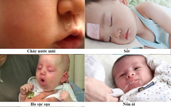 Bệnh ho gà có biểu hiện lâm sàng đặc trưng bởi những triệu chứng như ho, hắt hơi, sổ mũi, sốt nhẹ...