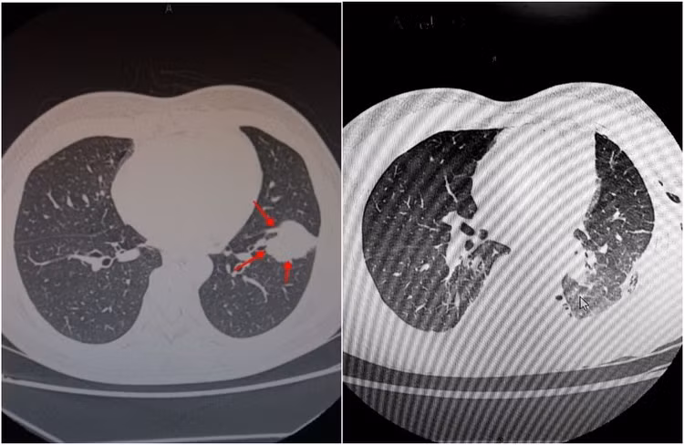 Hình ảnh chụp cắt lớp khối u phổi ác tính của bệnh nhân S. trước và sau khi phẫu thuật.