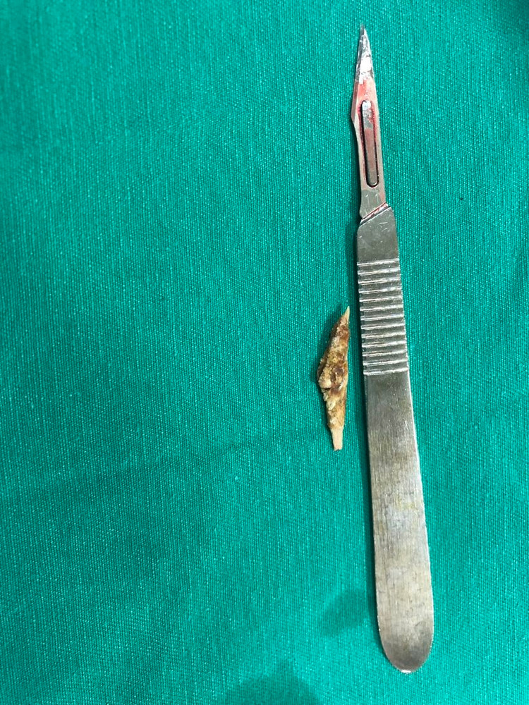 Xương gà trú ngụ nhiều năm đâm thủng trực tràng được lấy ra