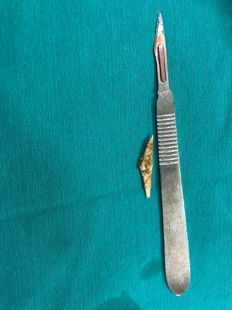 Xương gà trú ngụ nhiều năm đâm thủng trực tràng được lấy ra