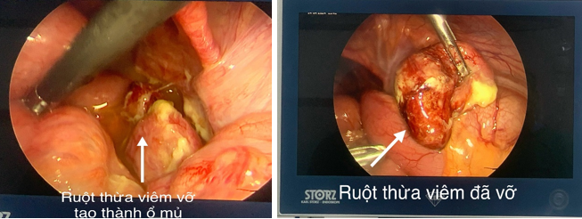 Hình ảnh ruột thừa vỡ quan sát trong mổ nội soi - Ảnh BVCC