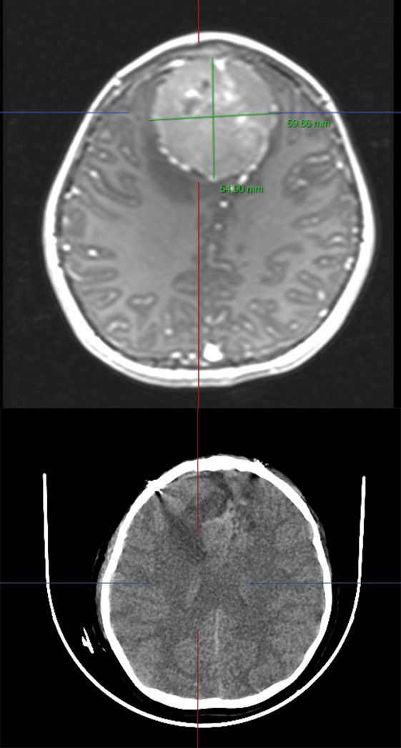 Kích thước khối u trên phim chụp - Ảnh BVCC