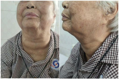 Hình ảnh người bệnh trước phẫu thuật, bướu cổ to