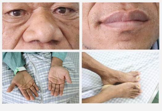 Các triệu chứng điển hình của người mắc bệnh u tuyến yên: môi dày, mũi to, da thô ráp, giọng nói ồm, và các xương đầu chi (tay, chân) to.