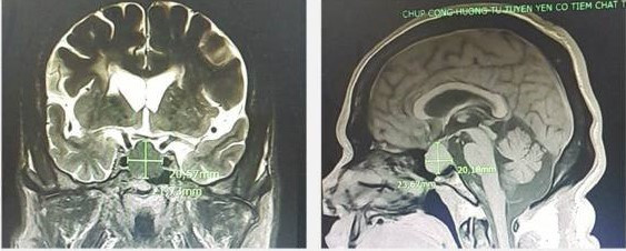 Hình ảnh khối u tuyến yên trên phim chụp cộng hưởng từ