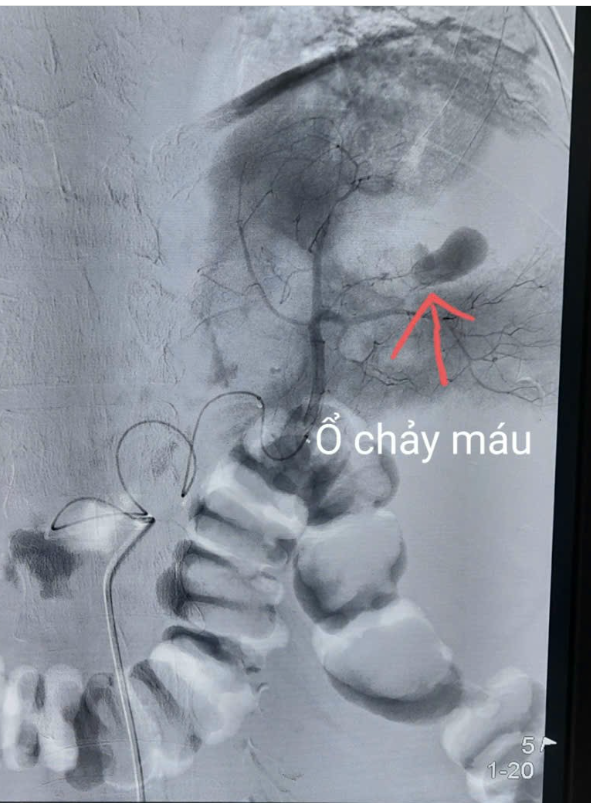 Hình ảnh ổ chảy máu trên máy chụp mạch DSA