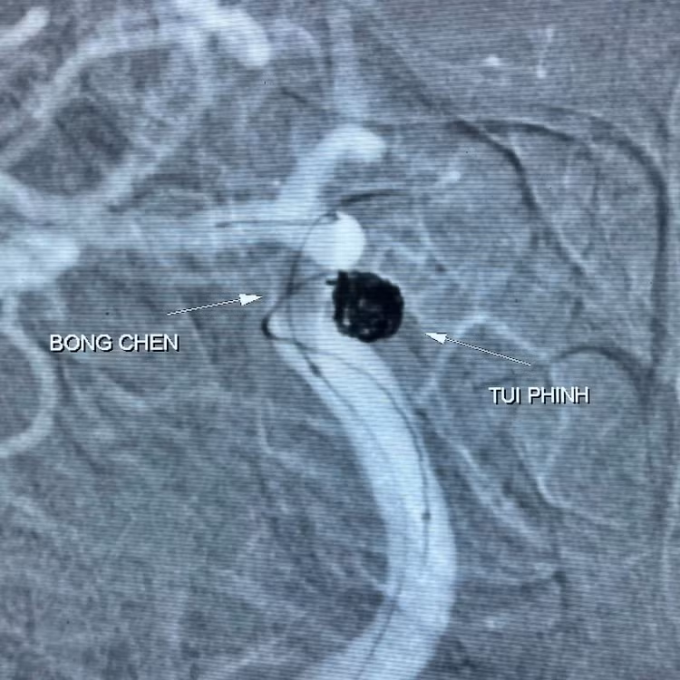 Nút phình mạch não với vòng xoắn kim loại kết hợp bóng chẹn ảnh 2