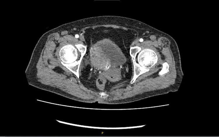 Hình ảnh tình trạng bệnh của bệnh nhân trên phim chụp