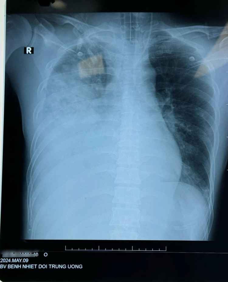 Tổn thương phổi do cúm B trên phim chụp - Ảnh BVCC Tổn thương phổi do cúm B trên phim chụp - Ảnh BVCC