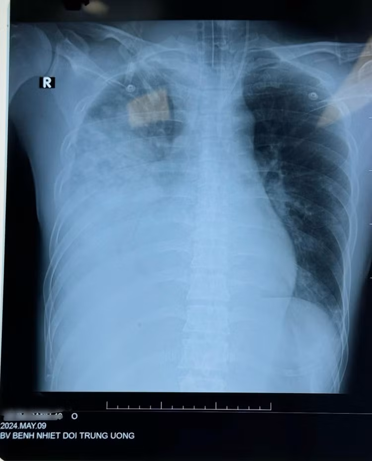 Tổn thương phổi do cúm B trên phim chụp - Ảnh BVCC