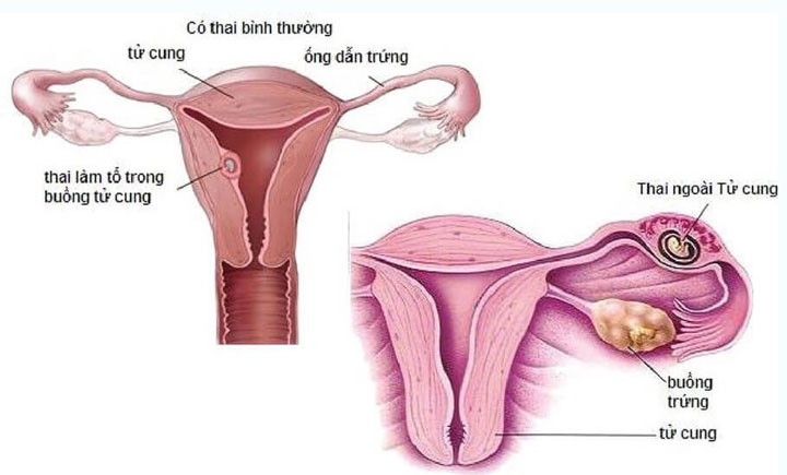 Biểu hiện của thai ngoài tử cung - Ảnh minh họa