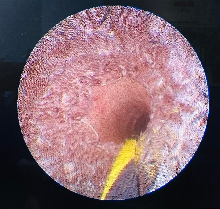 Hình ảnh niệu đạo sau khi đặt stent - Ảnh BSCC