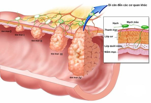 Bệnh Crohn có thể dẫn đến ung thư và di căn - Ảnh BVCC