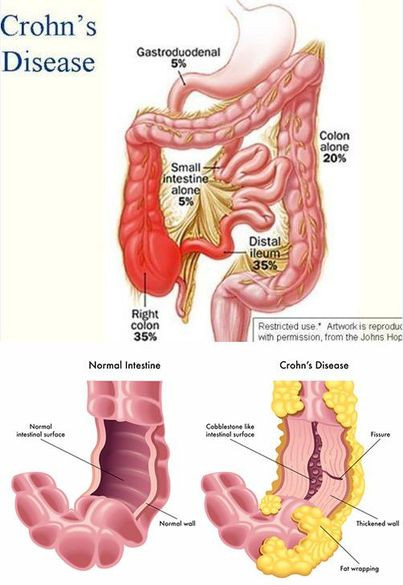 Xuất hiện ở bất kỳ vị trí nào của ống tiêu hóa - Ảnh BSCC