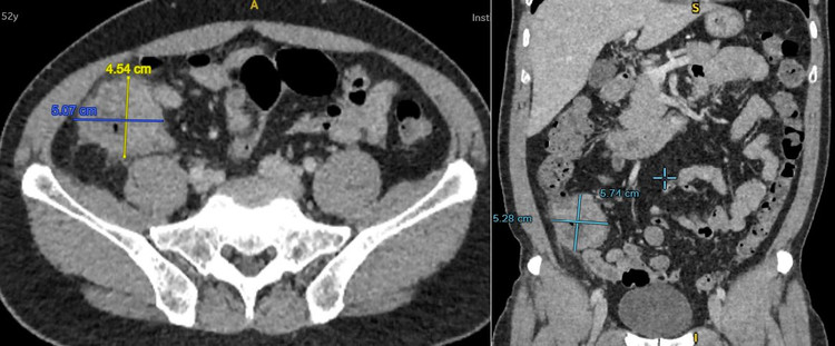 Biểu hiện của khối u trên phim chụp - Ảnh BVCC Biểu hiện của khối u trên phim chụp - Ảnh BVCC