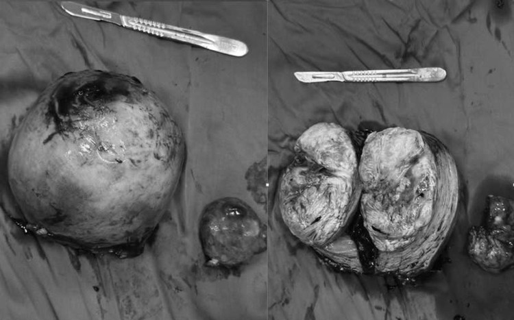 Hình ảnh khối u xơ tử cung kích thước lớn được lấy ra - Ảnh BVCC