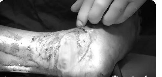 Tháo 300 ml mủ ở chân bé trai 12 tuổi do bong gân đắp lá cây - Ảnh BVCC Tháo 300 ml mủ ở chân bé trai 12 tuổi do bong gân đắp lá cây - Ảnh BVCC