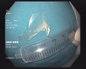 Nhiều người bị dị vật xương lớn mắc tại thực quản, phòng tránh thế nào? ảnh 2