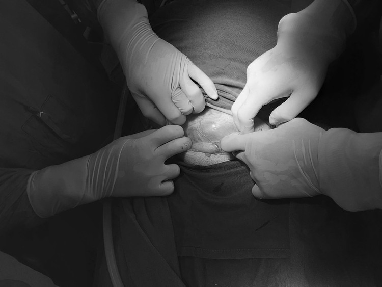 Nguy cơ vỡ tử cung vì vết sẹo cũ - Ảnh BVCC Nguy cơ vỡ tử cung vì vết sẹo cũ - Ảnh BVCC