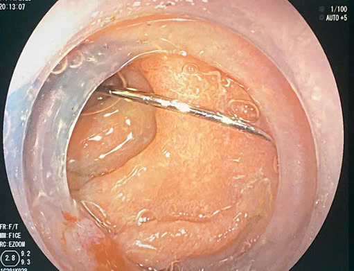Kim khâu trong tá tràng bệnh nhân - Ảnh BVCC