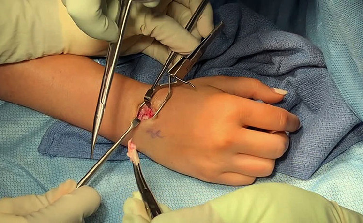 Phẫu thuật u bao hoạt dịch khớp cổ tay Phẫu thuật u bao hoạt dịch khớp cổ tay