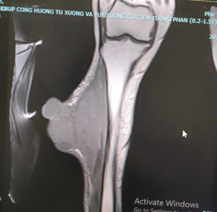 Hình ảnh khối u xâm lấn