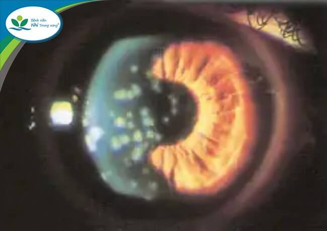 Hình ảnh giả mạc ở mắt trẻ khi bị viêm kết mạc cấp