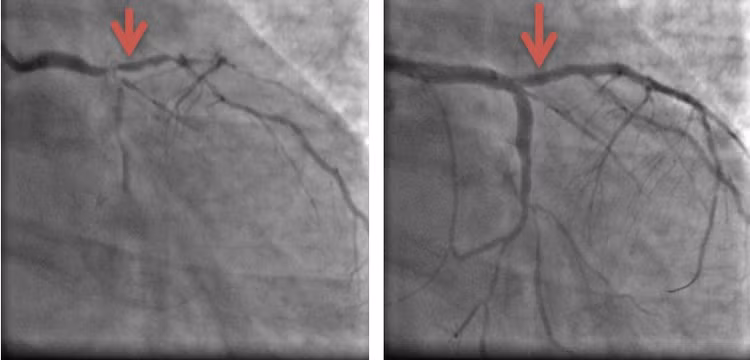 Hình ảnh trước và sau tái lưu thông thân chung động mạch vành trái