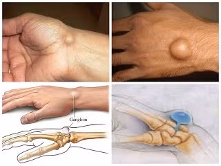 Địa chỉ vàng: Nơi điều trị u bao hoạt dịch khớp cổ tay ảnh 1