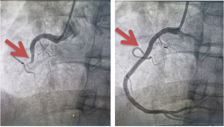 Hình ảnh động mạch vành phải bị tắc hoàn toàn và sau khi đã được tái lưu thông