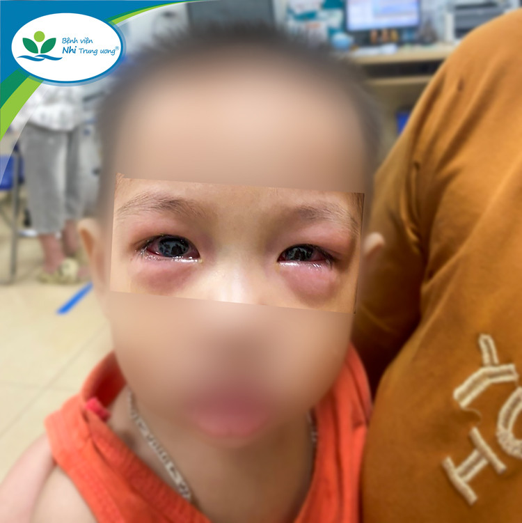 Dịch đau mắt đỏ diễn biến phức tạp: cẩn thận sẹo giác mạc, giảm thị lực