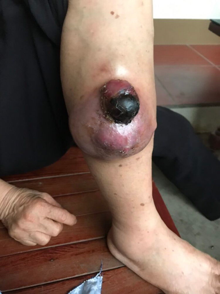 Hình ảnh khối u phát triển với kích thước lớn ở chân người bệnh