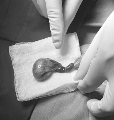 Tinh hoàn của bệnh nhi bị xoắn 3 vòng - Ảnh Bác sĩ cung cấp