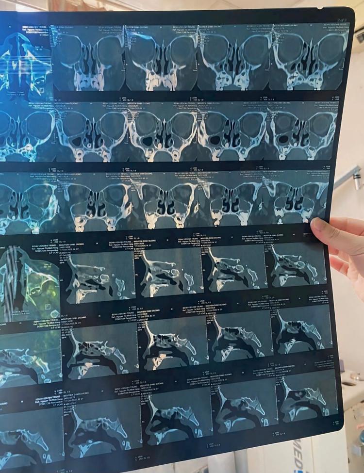 Răng mọc ở mũi trên phim chụp - Ảnh BVCC