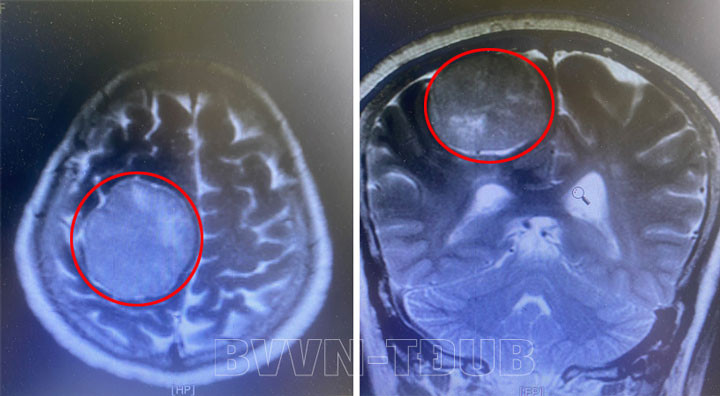Khối u não khổng lồ trên phim chụp