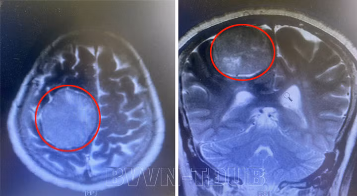 Khối u não khổng lồ trên phim chụp