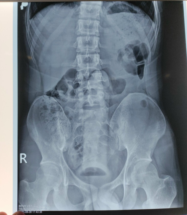 Qua phim X-Quang, các bác sĩ phát hiện dị vật đã chui sâu vào trong trực tràng của nam bệnh nhân