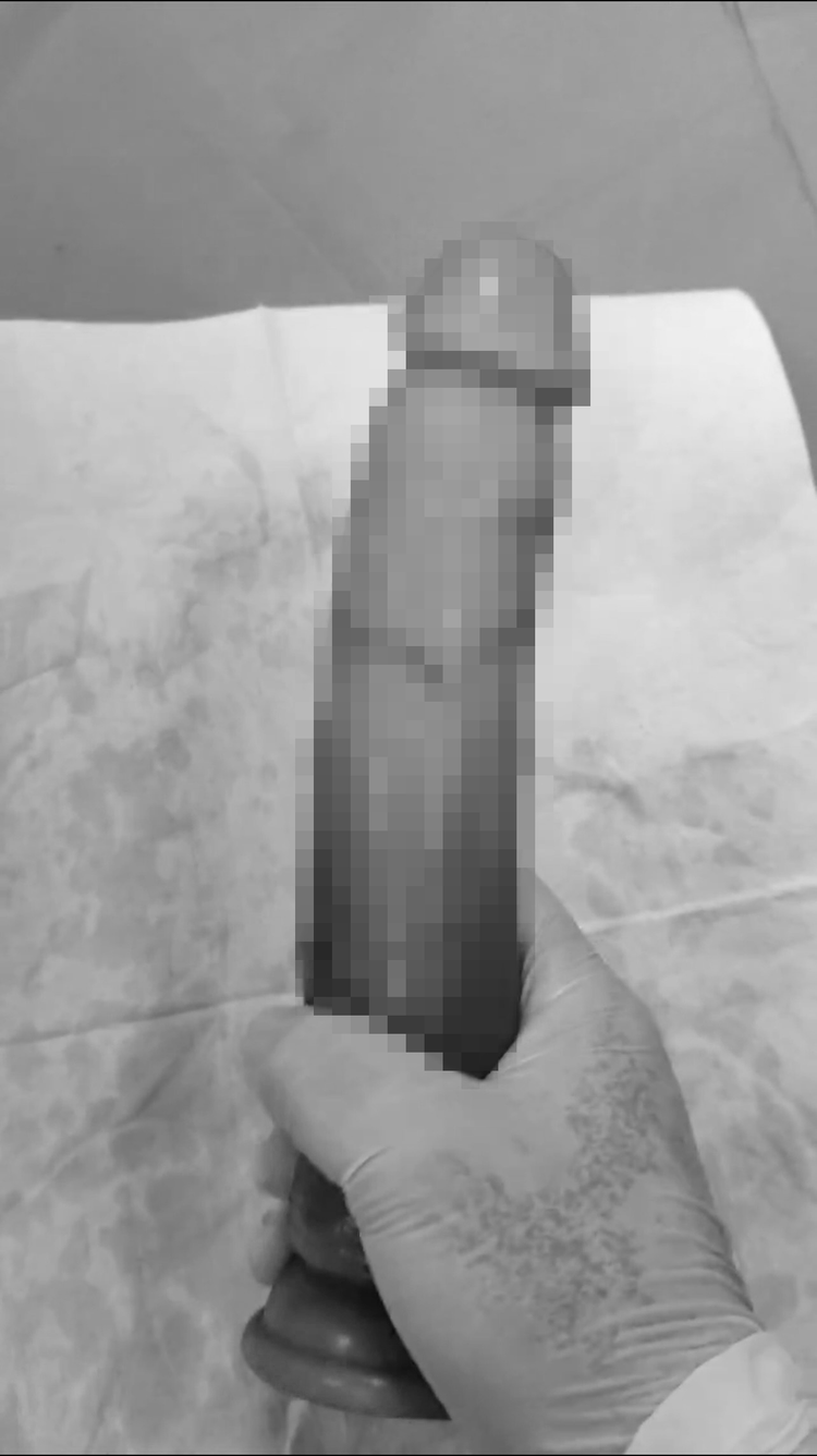 Dị vật được lấy ra là 1 dương vật giả với kích thước 25x5cm Dị vật được lấy ra là 1 dương vật giả với kích thước 25x5cm