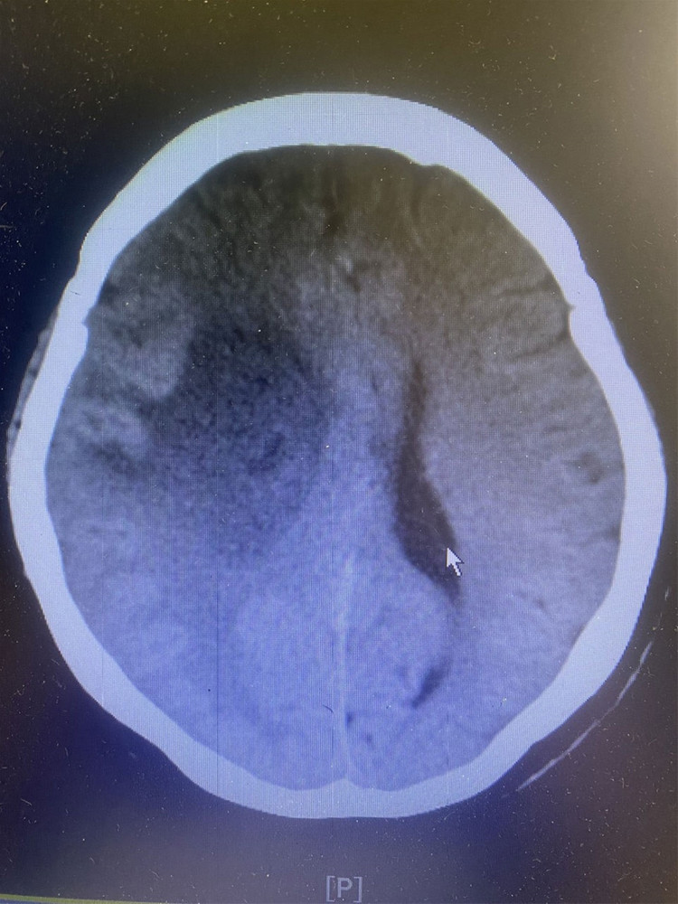 Phim chụp lại sau phẫu thuật