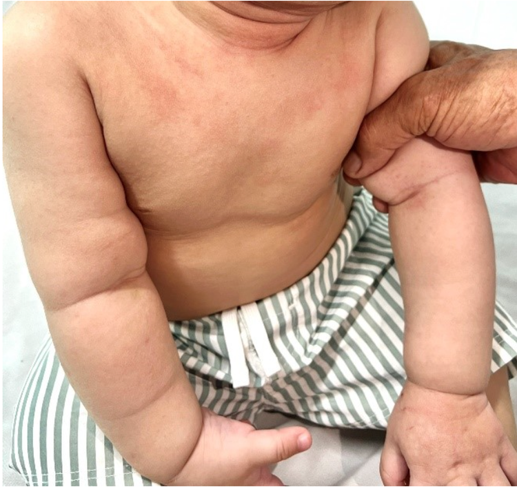 Triệu chứng dị ứng đạm sữa bò ở trẻ rất đa dạng - Ảnh BVCC