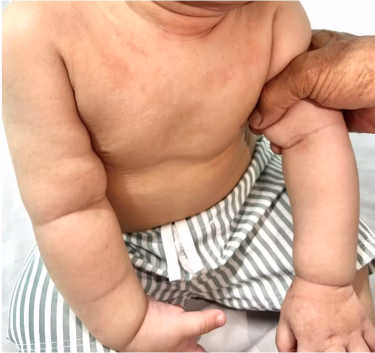 Triệu chứng dị ứng đạm sữa bò ở trẻ rất đa dạng - Ảnh BVCC