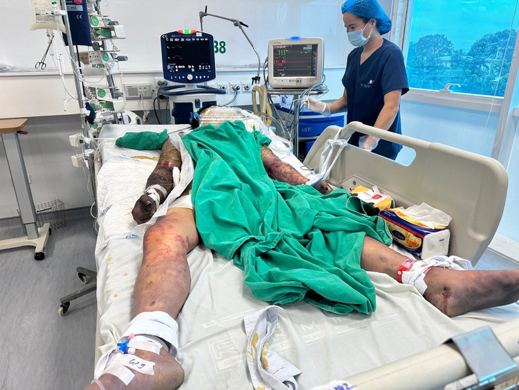 Nam bệnh nhân 27 tuổi bị nhiễm liên cầu khuẩn lợn đang được chăm sóc, điều trị tích cực tại Bệnh viện Bệnh nhiệt đới trung ương. Ảnh: Bệnh viện cung cấp