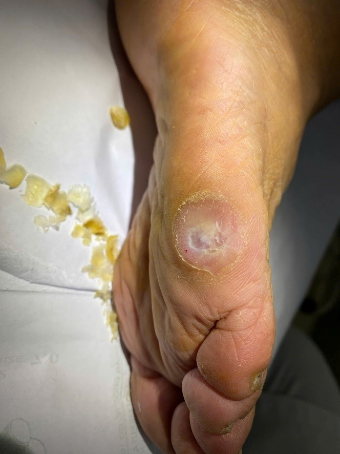 Bác sĩ mách cách chăm sóc và điều trị chai chân ảnh 2